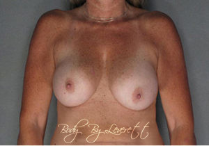 Body by Leverett Before and After Images