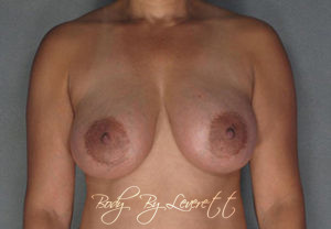 Body by Leverett Before and After Images