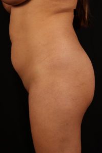 Body by Leverett Before and After Images