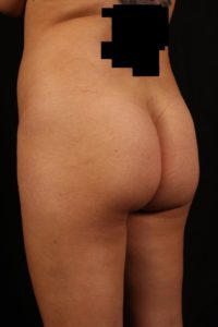 Body by Leverett Before and After Images