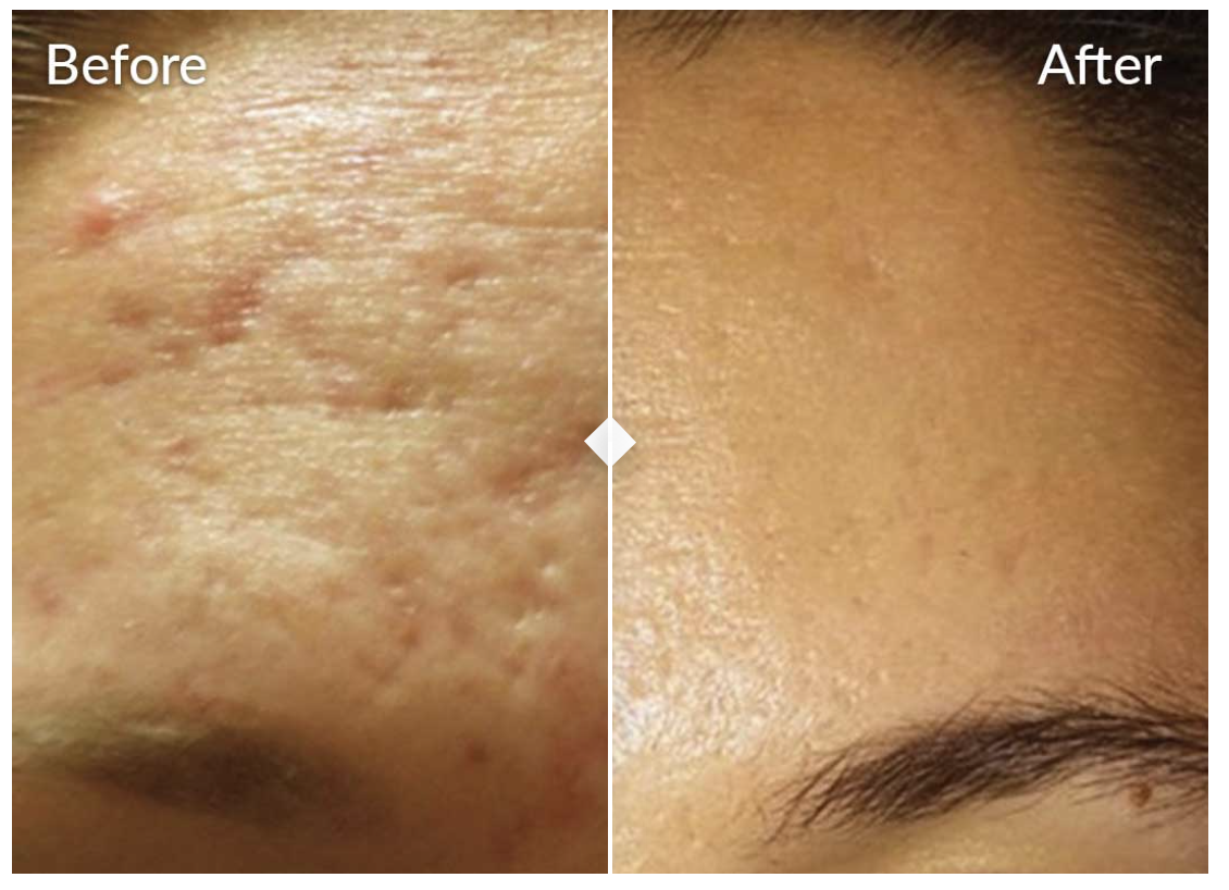 Microneedling in Phoenix, AZ